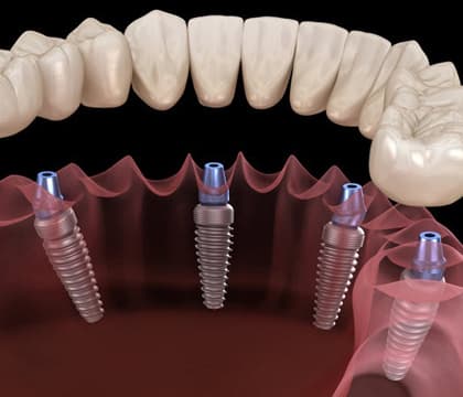 All-on-4 Implants