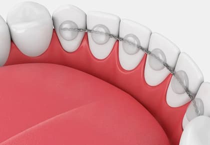 Cosmetic Bonding