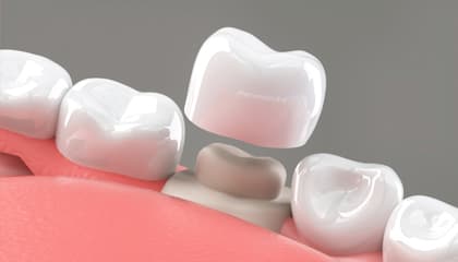 Same Day Crowns