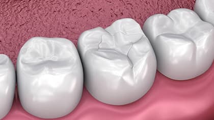 Dental Sealants