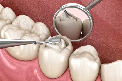 Dental Filling