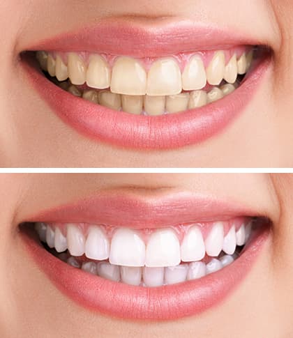 Teeth Whitening