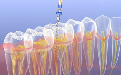Root Canal Therapy